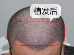 -大麦微针植发全国连锁