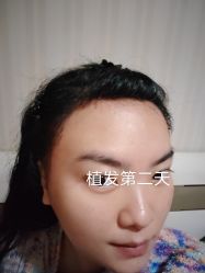 -碧莲盛·不剃发植发