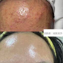 -美肤盾祛痘·问题肌头疗管理中心