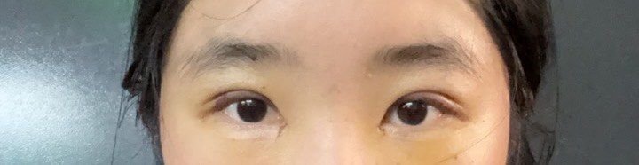 体验后-苏州维多利亚美容医院
