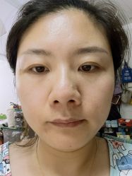 体验后-亿美医疗美容·半岛大超炮官方授权店