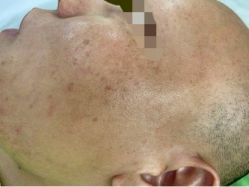 -苗医生草本科技祛痘