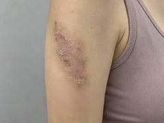 -杭州仁易堂中医康复医院疤痕修复