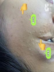 -爱莎扁平疣·汗管瘤·斑痣中心