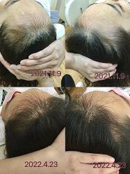 -菩叶脱发白发中心
