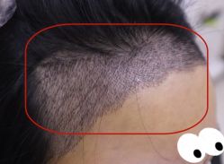 -大麦微针植发全国连锁