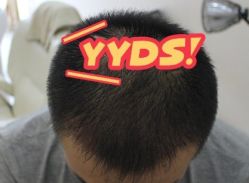 -大麦微针植发丨全国连锁