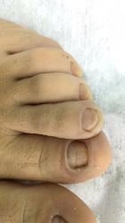 点击看大图 -德哥灰指甲脚气甲沟炎跖疣护理