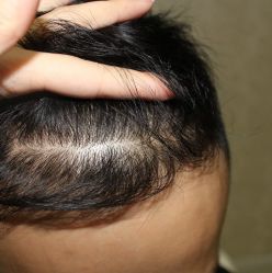 -大麦微针植发全国连锁