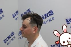 点击看大图 -大麦微针植发丨全国连锁