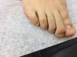 -德哥灰指甲脚气甲沟炎跖疣护理