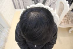 点击看大图 -大麦微针植发丨全国连锁