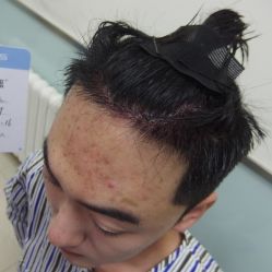 点击看大图 -碧莲盛·不剃发植发