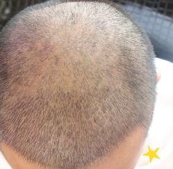 -大麦微针植发丨全国连锁