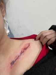-一次性洗纹身·修复疤痕·超皮秒