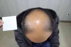 -大麦微针植发丨全国连锁