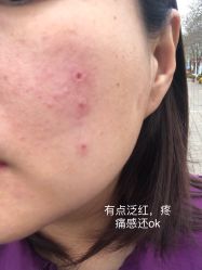 体验后-东剑医学美容·注射美学中心