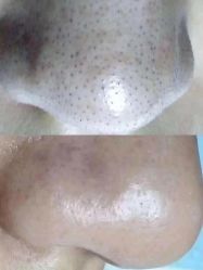 -蕾特恩专业祛痘