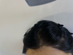 -碧莲盛·不剃发植发