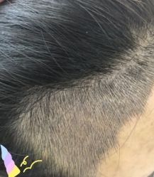 -大麦微针植发丨全国连锁