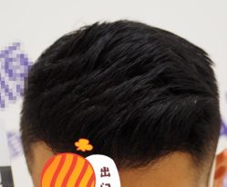 -大麦微针植发全国连锁