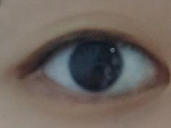 -黑马眼科·近视手术