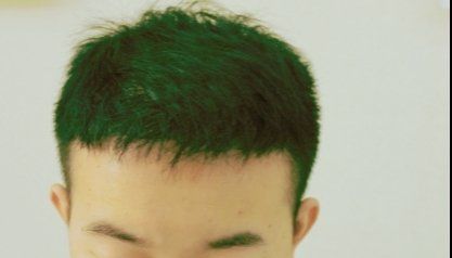-大麦微针植发丨全国连锁