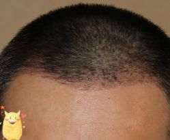 -大麦微针植发丨全国连锁