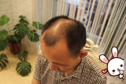 -大麦微针植发丨全国连锁