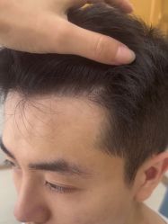 点击看大图 体验后-大麦微针植发丨全国连锁