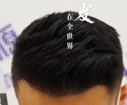 -大麦微针植发全国连锁