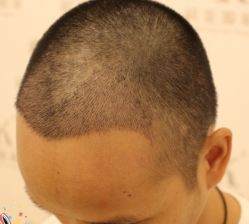 -大麦微针植发丨全国连锁