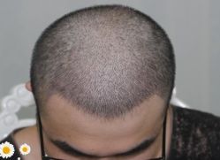 -大麦微针植发丨全国连锁