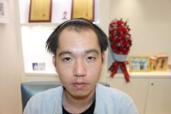 -大麦微针植发丨全国连锁