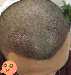 -大麦微针植发丨全国连锁