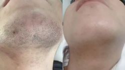 点击看大图 -ANRI安里·专业男士脱毛连锁