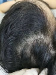 体验后-大麦微针植发全国连锁