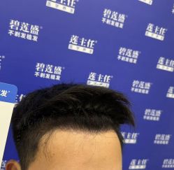 -碧莲盛·不剃发植发