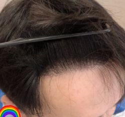 -大麦微针植发丨全国连锁