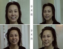 拉皮除皱-新雅韩整形美容医院
