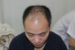 -大麦微针植发丨全国连锁