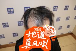 点击看大图 -大麦微针植发全国连锁
