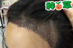 -大麦微针植发丨全国连锁