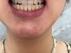 -上海仁爱医院口腔科 · 种植