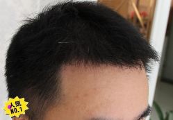 -大麦微针植发丨全国连锁