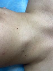 体验前-爱莎扁平疣·汗管瘤·斑痣中心