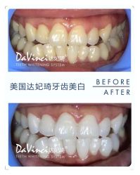 牙齿美白-光SPA科技美肤