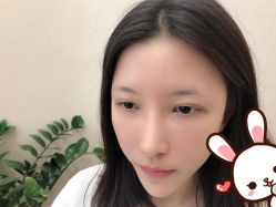 -大麦微针植发丨全国连锁