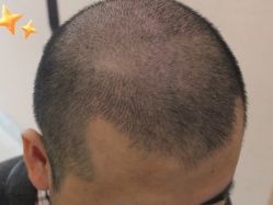 -大麦微针植发丨全国连锁