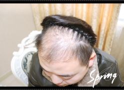 点击看大图 体验后-大麦微针植发全国连锁